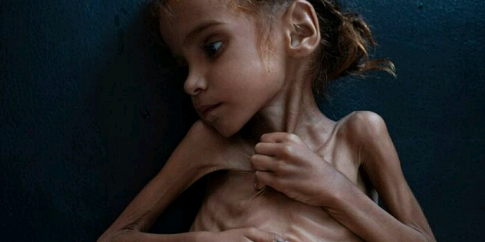 مأساة الطفلة أمل باليمن التي هزت ضمير العالم بعدما قتلها الجوع. فيديو