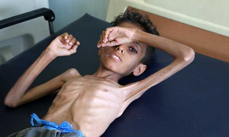 الظروف المعيشية لأطفال اليمن عار على البشرية