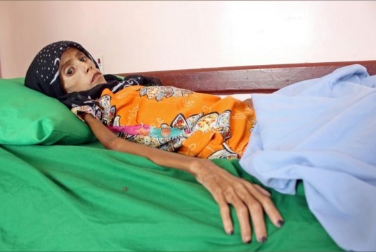 اليمن ضمن أكثر 8 دول مهددة بالمجاعة