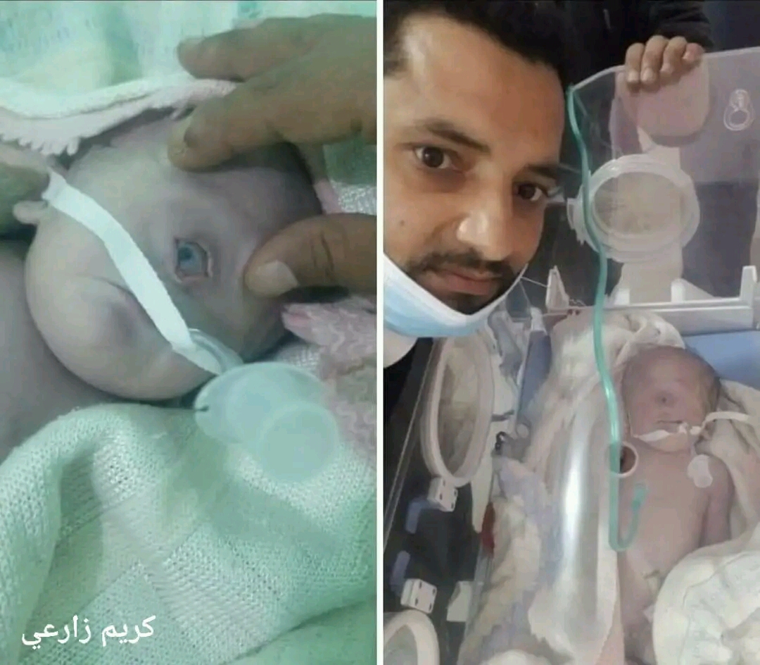 شاهد.. ولادة طفل يمني بعين واحدة في حالة نادرة جدا على مستوى العالم