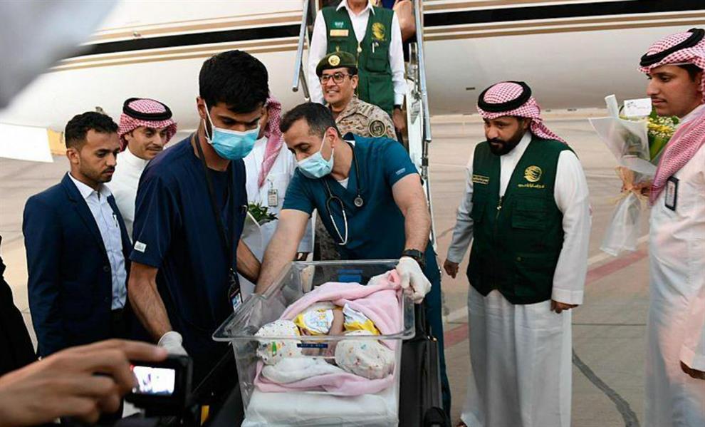 سيشارك فيها 28 طبيبًا ..مسؤول سعودي يكشف موعد إجراء عملية فصل التوأم السيامي اليمني