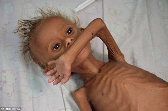 تسجيل أكثر من 120 ألف طفل يمني مصاب بسوء التغذية الحاد في النصف الأول من العام الجاري