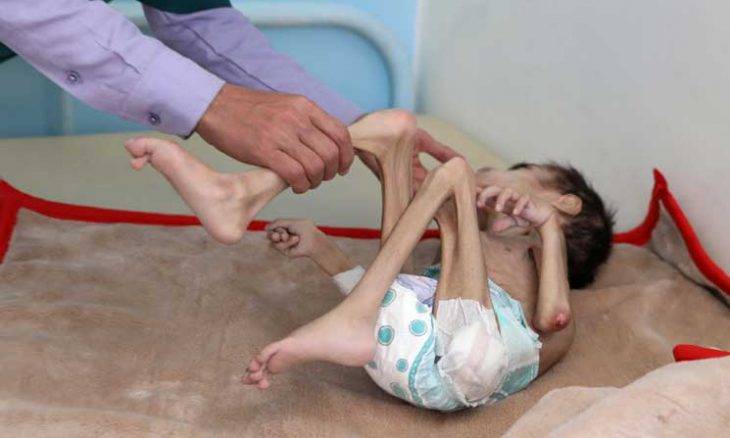دعوة أممية عاجلة لإنقاذ ملايين اليمنيين من خطر المجاعة
