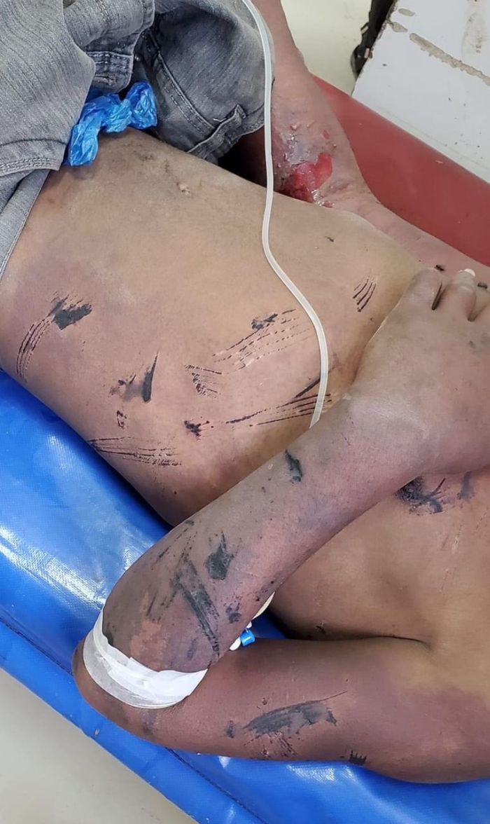 صورة لمأساة جديدة...  وفاة أحد المخفين قسرا في سجون مليشيا الحوثي الإرهابية متأثرا بما تعرض له من تعذيب