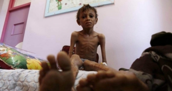 اليمن في أعلى معدلات الجوع من بين 17 دولة مشمولة ..تقرير