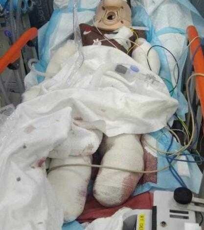وفاة طفل يمني بأحد المستشفيات السعودية جراء إصابته بلغم حوثي