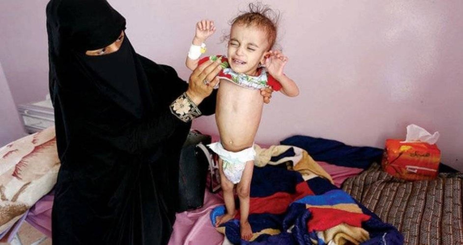 ألفا يمني ماتوا بالملاريا خلال شهرين .. وأكثر من 82 ألف إصابة في 8 محافظات تسيطر عليها المليشيات